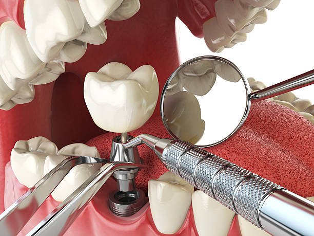 Tooth Infection Emergency Dentist in IA